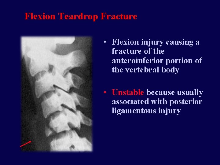 Flexion Teardrop Fracture • Flexion injury causing a fracture of the anteroinferior portion of