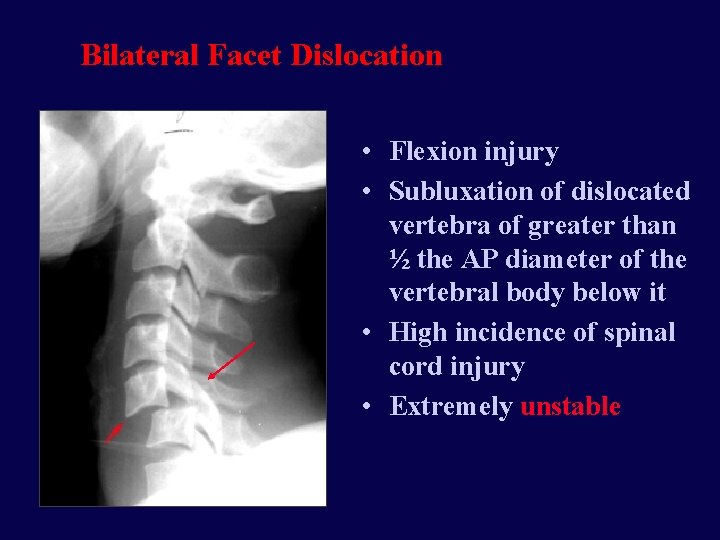 Bilateral Facet Dislocation • Flexion injury • Subluxation of dislocated vertebra of greater than