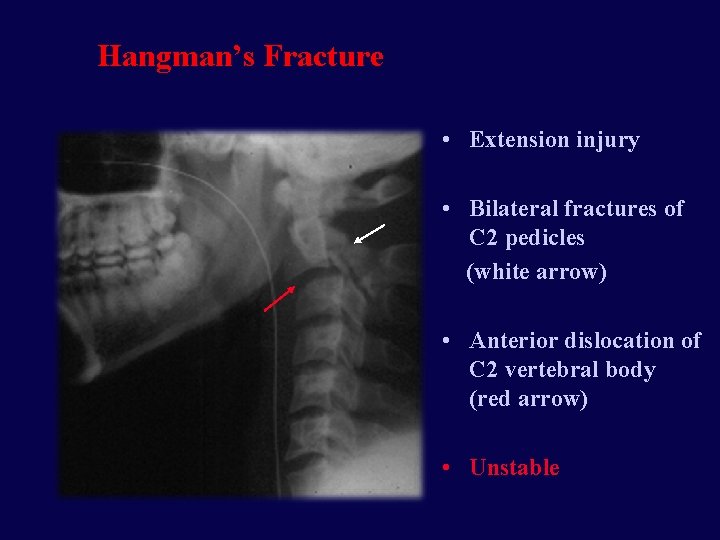 Hangman’s Fracture • Extension injury • Bilateral fractures of C 2 pedicles (white arrow)