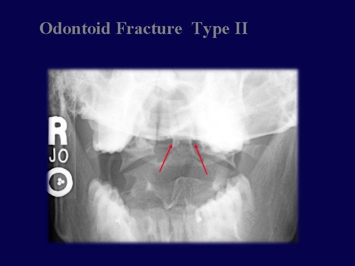 Odontoid Fracture Type II 