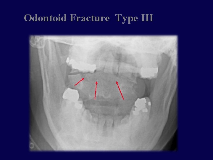 Odontoid Fracture Type III 