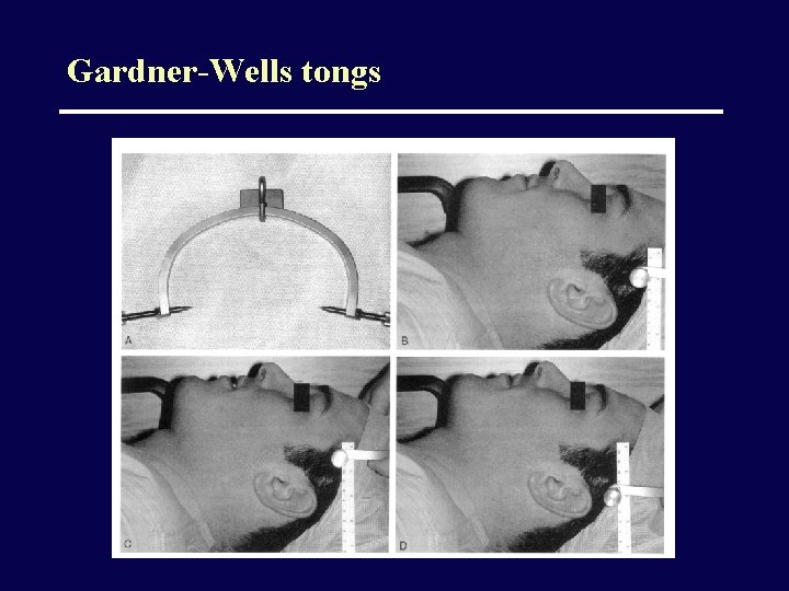 Gardner-Wells tongs 