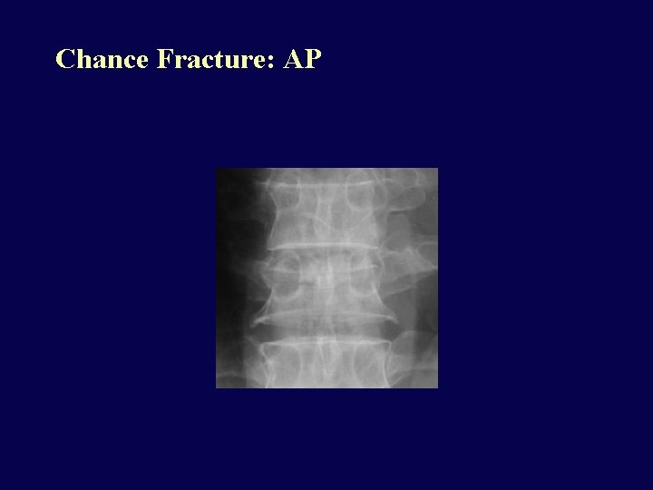 Chance Fracture: AP 