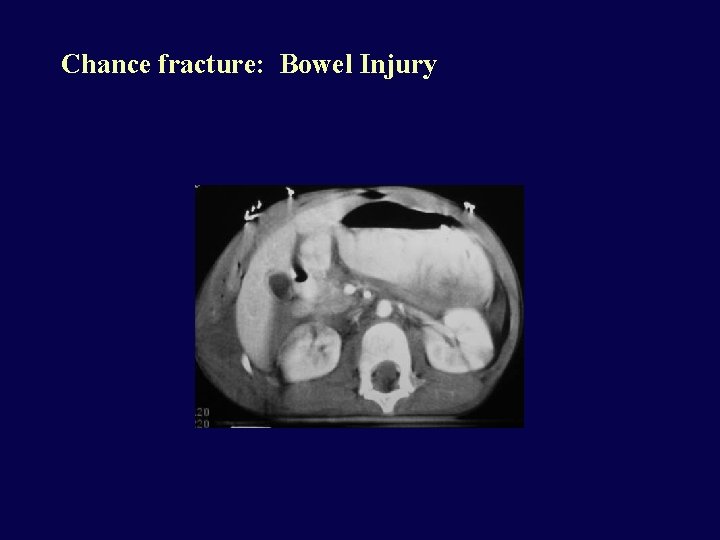 Chance fracture: Bowel Injury 