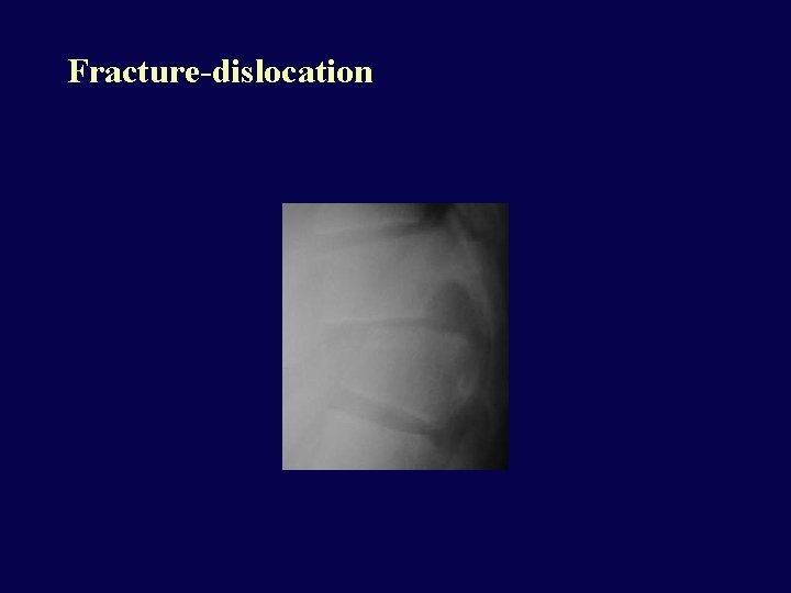 Fracture-dislocation 