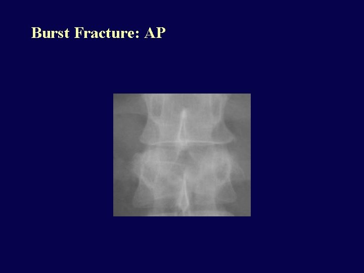 Burst Fracture: AP 