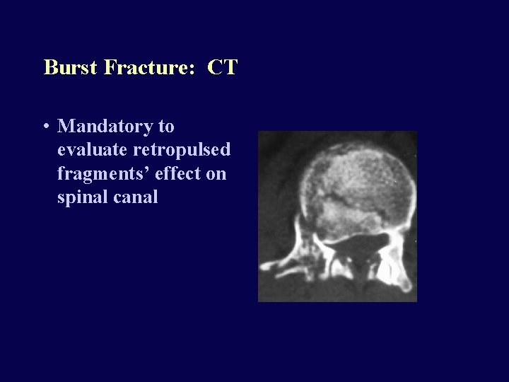Burst Fracture: CT • Mandatory to evaluate retropulsed fragments’ effect on spinal canal 