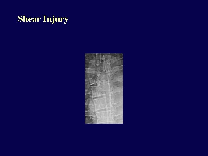 Shear Injury 