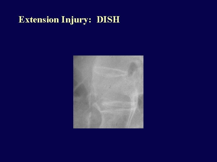 Extension Injury: DISH 