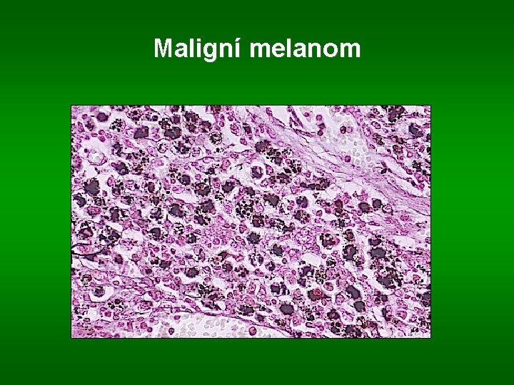 Maligní melanom 