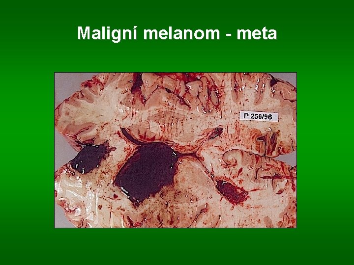 Maligní melanom - meta 