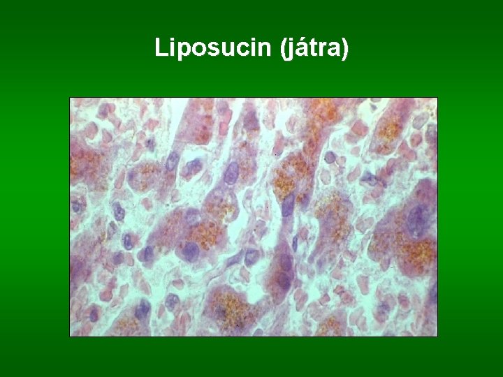 Liposucin (játra) 