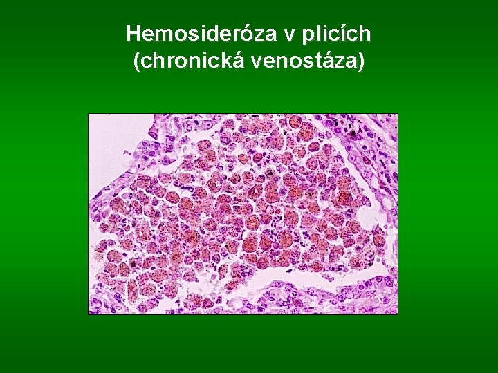 Hemosideróza v plicích (chronická venostáza) 