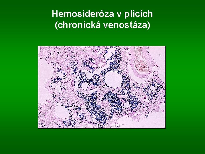Hemosideróza v plicích (chronická venostáza) 
