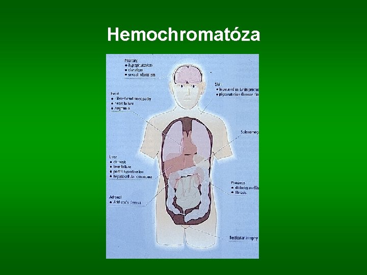Hemochromatóza 