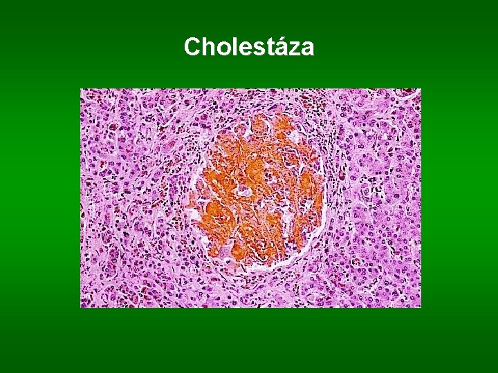 Cholestáza 