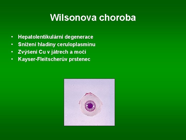 Wilsonova choroba • • Hepatolentikulární degenerace Snížení hladiny ceruloplasminu Zvýšení Cu v játrech a