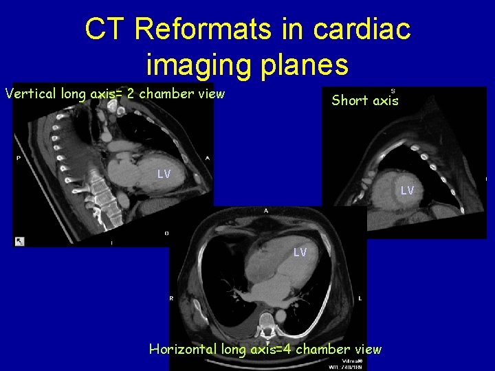 CT Reformats in cardiac imaging planes Vertical long axis= 2 chamber view Short axis