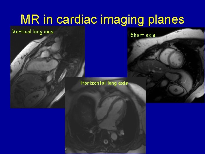 MR in cardiac imaging planes Vertical long axis Short axis Horizontal long axis 