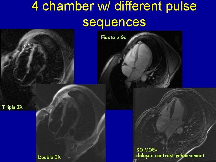 4 chamber w/ different pulse sequences Fiesta p Gd Triple IR Double IR 3