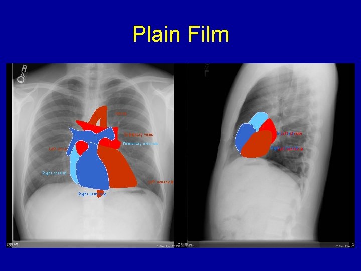 Plain Film Aorta Pulmonary veins Pulmonary arteries Left atrium Right atrium Left ventricle Right.