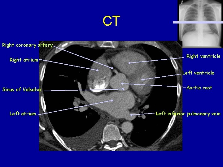 CT Right coronary artery Right atrium Right ventricle Left ventricle Sinus of Valsalva Left