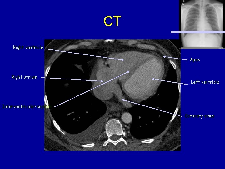 CT Right ventricle Apex Right atrium Left ventricle Interventricular septum Coronary sinus 