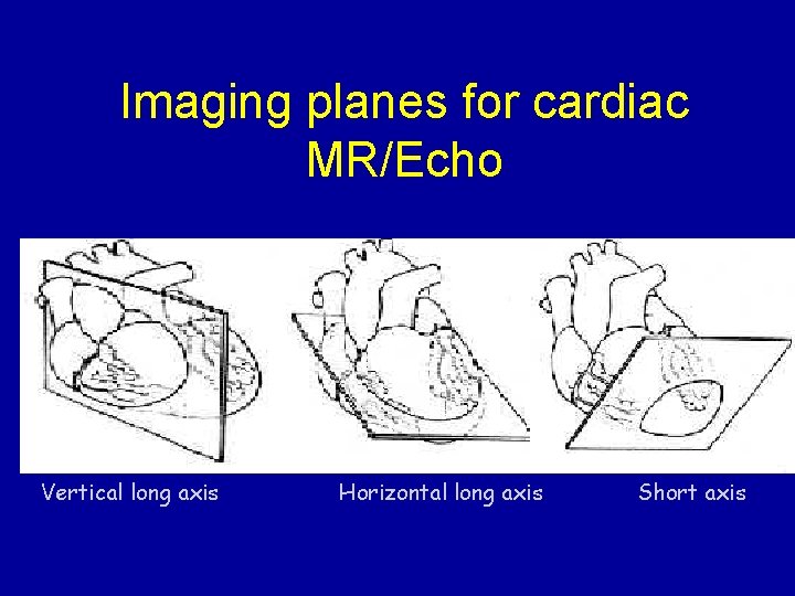 Imaging planes for cardiac MR/Echo Vertical long axis Horizontal long axis Short axis 