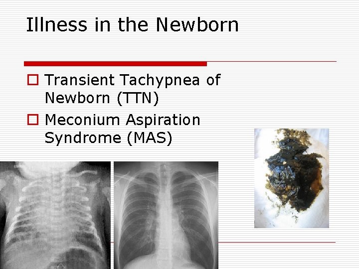 Illness in the Newborn o Transient Tachypnea of Newborn (TTN) o Meconium Aspiration Syndrome