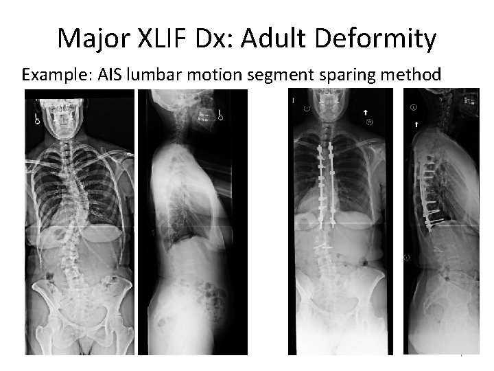 Major XLIF Dx: Adult Deformity Example: AIS lumbar motion segment sparing method 7 
