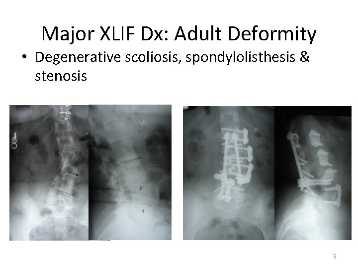 Major XLIF Dx: Adult Deformity • Degenerative scoliosis, spondylolisthesis & stenosis 8 