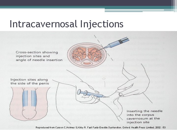 Intracavernosal Injections Reproduced from Carson C, Holmes S, Kirby R. Fast Facts-Erectile Dysfunction. Oxford: