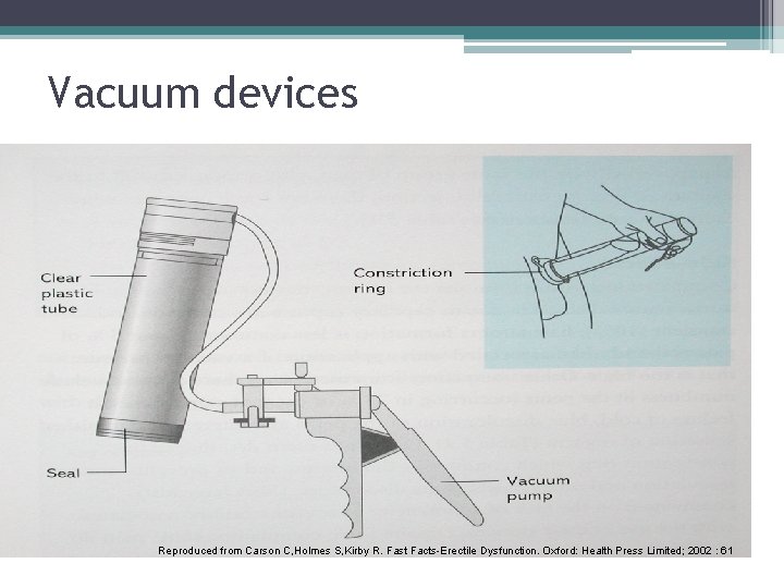 Vacuum devices Reproduced from Carson C, Holmes S, Kirby R. Fast Facts-Erectile Dysfunction. Oxford: