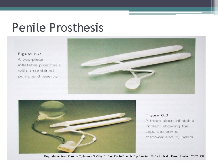 Penile Prosthesis Reproduced from Carson C, Holmes S, Kirby R. Fast Facts-Erectile Dysfunction. Oxford: