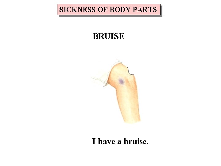 SICKNESS OF BODY PARTS BRUISE I have a bruise. 