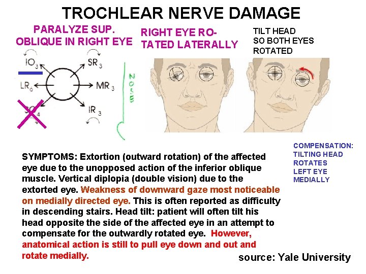 TROCHLEAR NERVE DAMAGE PARALYZE SUP. RIGHT EYE ROOBLIQUE IN RIGHT EYE TATED LATERALLY TILT
