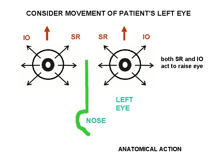 CONSIDER MOVEMENT OF PATIENT'S LEFT EYE IO SR SR IO both SR and IO