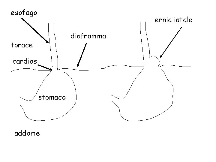 esofago ernia iatale diaframma torace cardias stomaco addome 