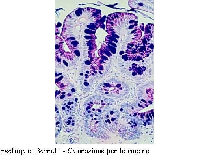 Esofago di Barrett - Colorazione per le mucine 