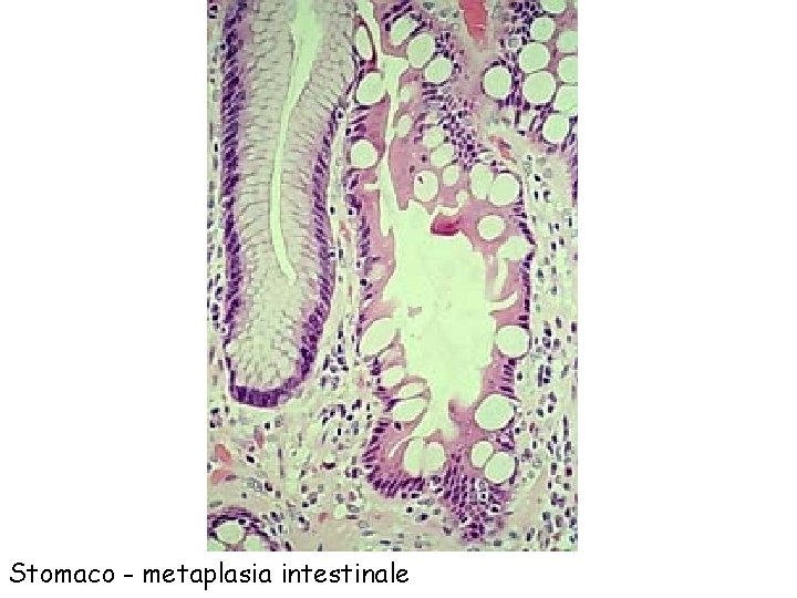 Stomaco - metaplasia intestinale 