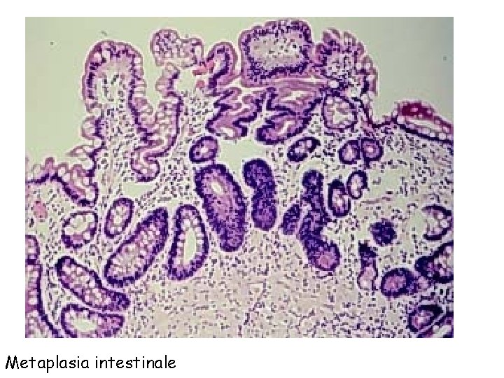 Metaplasia intestinale 