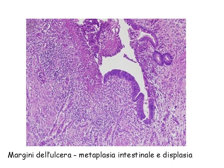 Margini dell’ulcera - metaplasia intestinale e displasia 