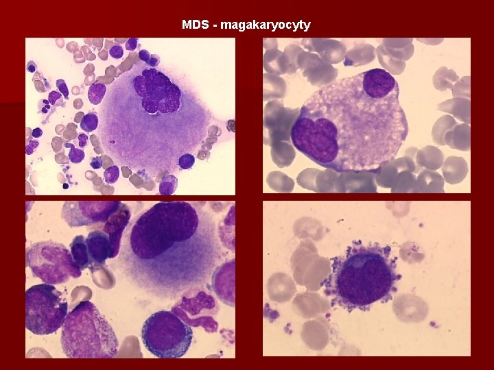 MDS - magakaryocyty 