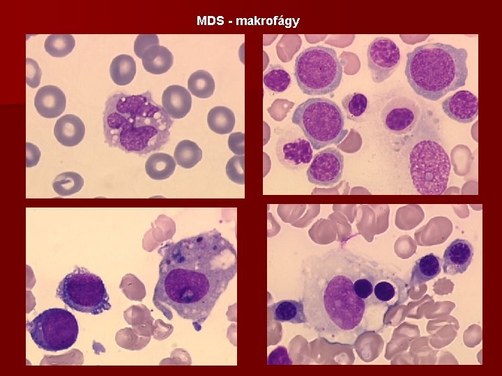 MDS - makrofágy 