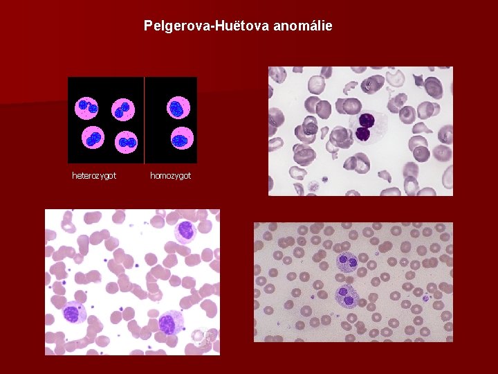 Pelgerova-Huëtova anomálie heterozygot homozygot 