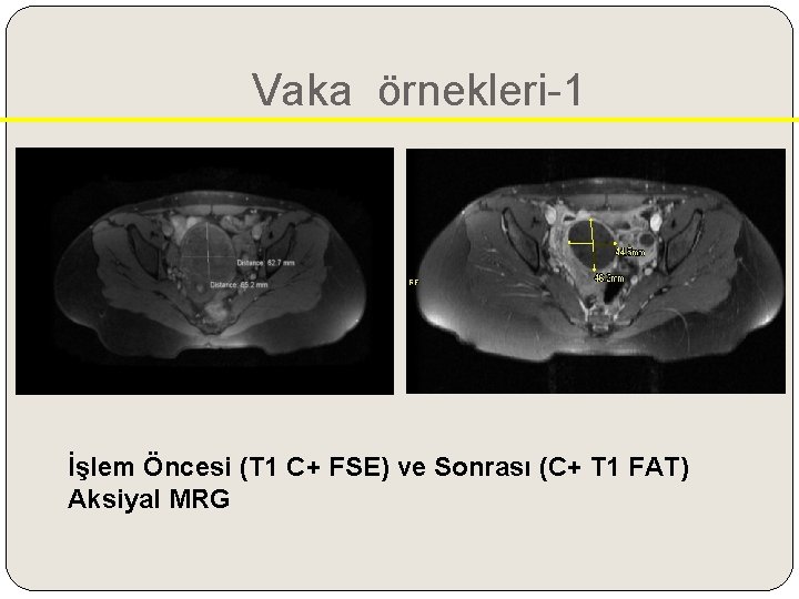 Vaka örnekleri-1 İşlem Öncesi (T 1 C+ FSE) ve Sonrası (C+ T 1 FAT)