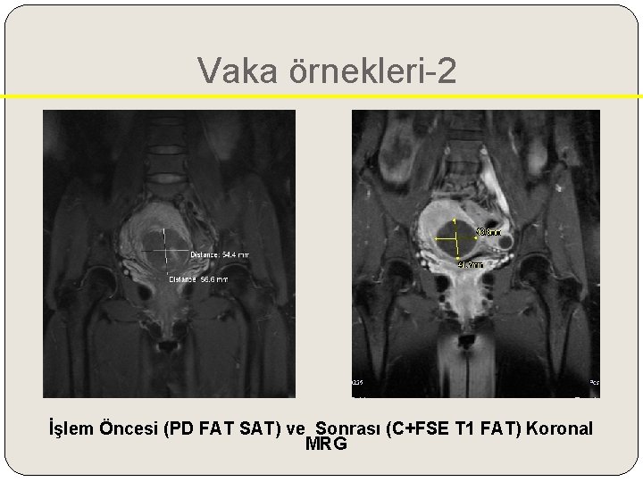 Vaka örnekleri-2 İşlem Öncesi (PD FAT SAT) ve Sonrası (C+FSE T 1 FAT) Koronal