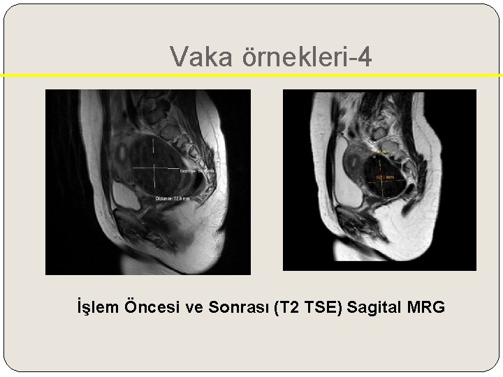 Vaka örnekleri-4 İşlem Öncesi ve Sonrası (T 2 TSE) Sagital MRG 