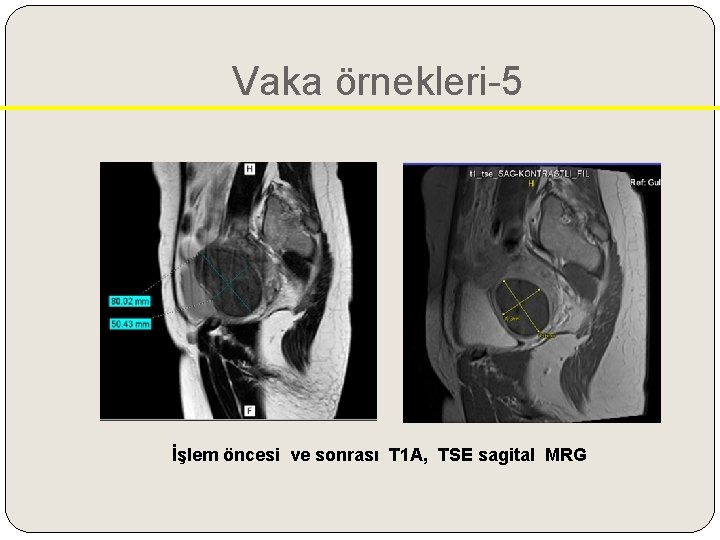 Vaka örnekleri-5 İşlem öncesi ve sonrası T 1 A, TSE sagital MRG 