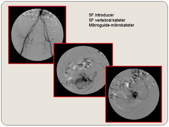 5 F introducer 5 F vertebral kateter Mikroguide-mikrokateter 